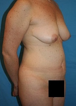 Mommy Makeover Before & After