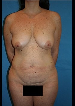 Mommy Makeover Before & After