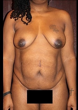 Mommy Makeover Before & After