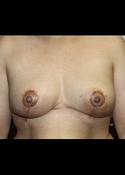 Breast Reduction Before & After