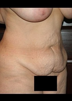Tummy Tuck Before & After