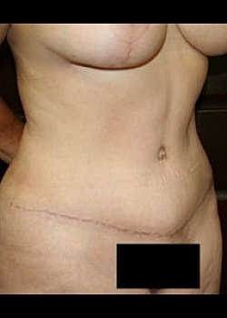 Tummy Tuck Before & After