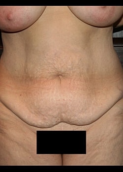 Tummy Tuck Before & After