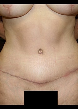 Tummy Tuck Before & After
