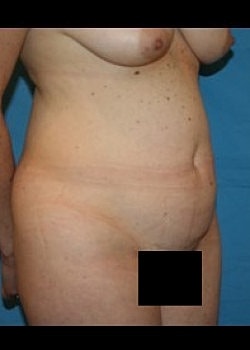 Tummy Tuck Before & After