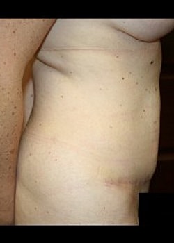 Tummy Tuck Before & After