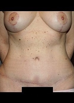 Tummy Tuck Before & After