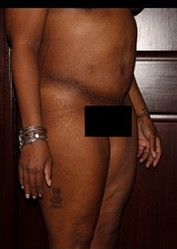 Tummy Tuck Before & After