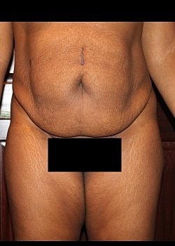 Tummy Tuck Before & After