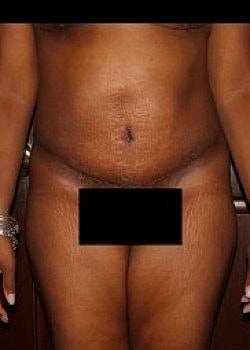 Tummy Tuck Before & After