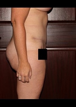 Tummy Tuck Before & After