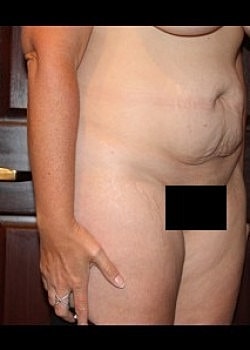 Tummy Tuck Before & After
