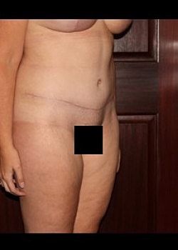 Tummy Tuck Before & After