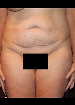 Tummy Tuck Before & After