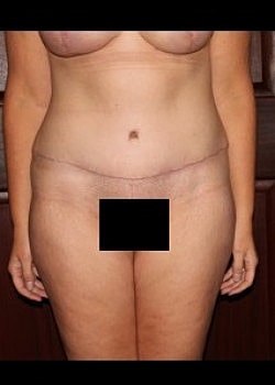 Tummy Tuck Before & After
