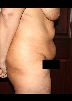 Tummy Tuck Before & After