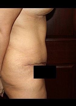 Tummy Tuck Before & After