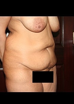 Tummy Tuck Before & After