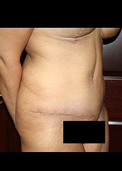 Tummy Tuck Before & After