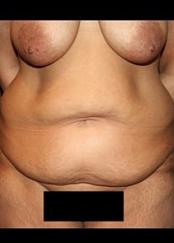 Tummy Tuck Before & After