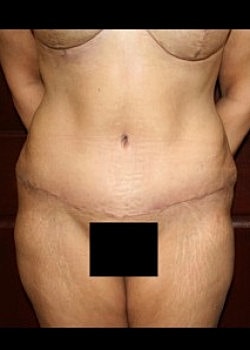 Tummy Tuck Before & After