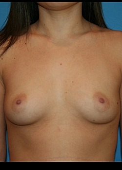 Breast Augmentation Before & After