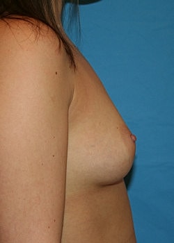 Breast Augmentation Before & After