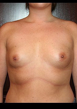 Breast Augmentation Before & After