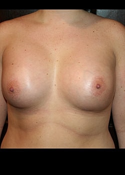 Breast Augmentation Before & After