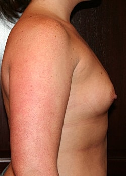Breast Augmentation Before & After