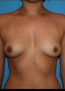 Breast Augmentation Before & After