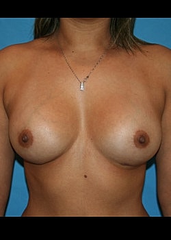 Breast Augmentation Before & After